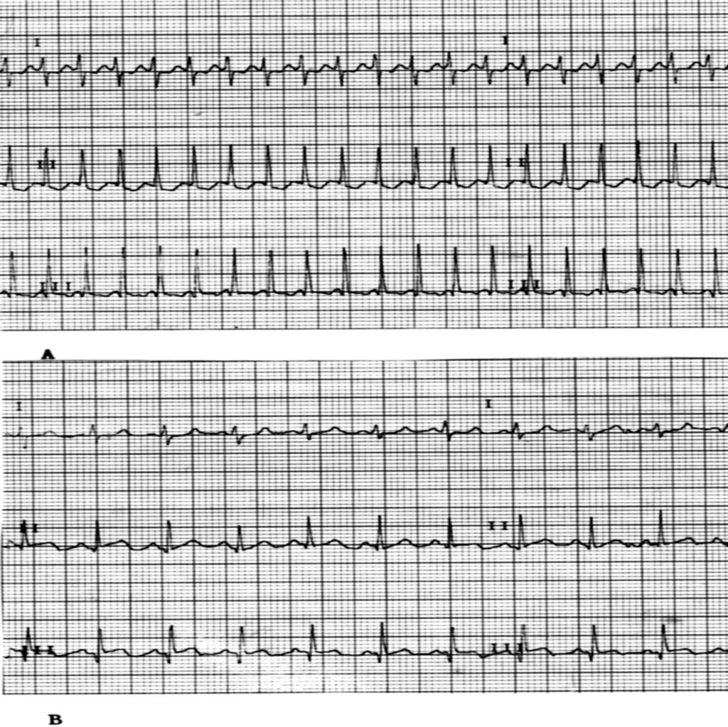 Dar QRS