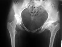 FEMUR ÜST UÇ OSTEOTOMILERI Operasyon öncesi Hazırlık Standart olarak çekilmiģ