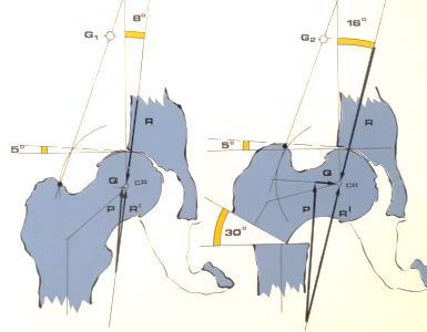 FEMUR ÜST UÇ OSTEOTOMILERI Varus osteotomisi Coxa valga subluksans hastalarında femur baģına dik olarak gelen R kuvvetinin daha yatay
