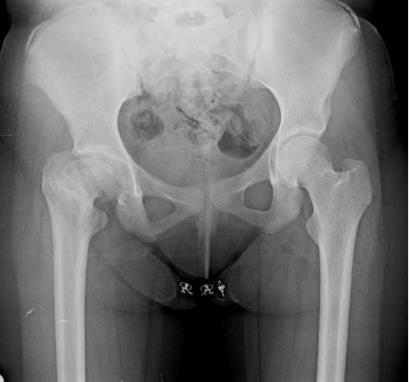 KOMPLEKS FEMUR PROKSIMAL OSTEOTOMILERI Koksa vara Koksa