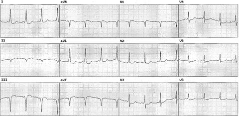 Sağ posteroseptal aksesuar yol Haghjoo