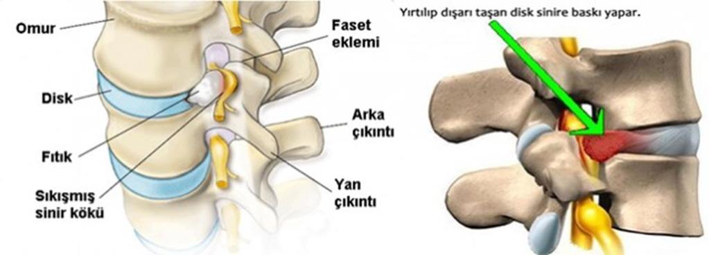 BOYUN FITIKLARI VE SERVİKAL RADİKULOPATİ Bir yeriniz ağrıdığı zaman ağrının kaynağını bulmak çok zor değildir.