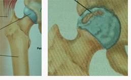 KALÇA OSTEOARTRİTİ (KİREÇLENMESİ) Kalça eklemi ağırlığınızı taşıdığı için aşınma ve bozulmaya en sık uğrayan eklemlerdendir.