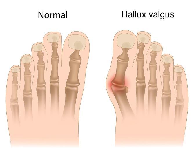 HALLUKS VALGUS (Ayak başparmağında çıkıntı) Ayak