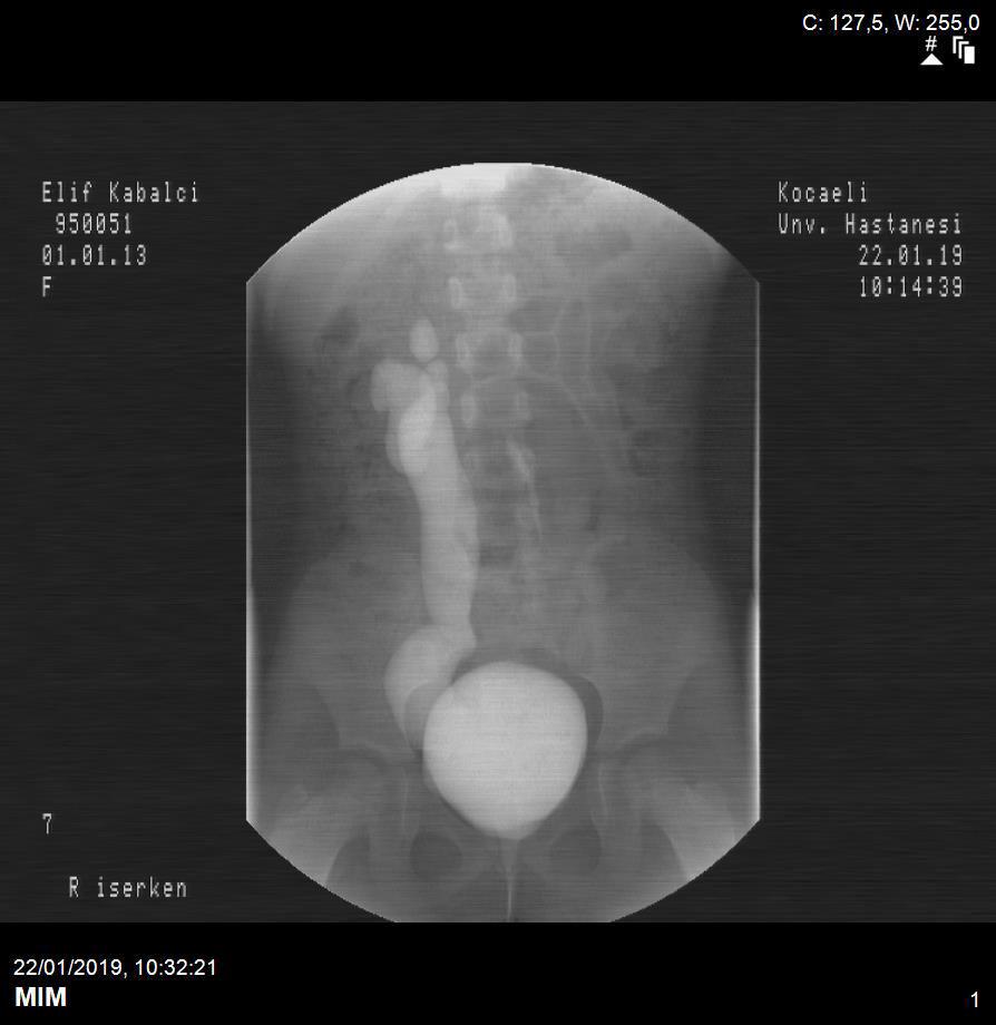 Voiding Sisto Üretrografisi 22/01/2019 Sağda grade 5 vezikoüreteral