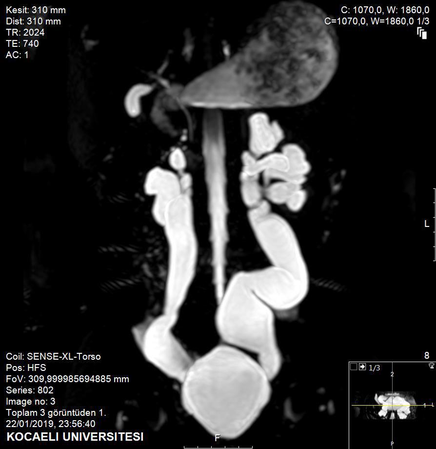 MR- Ürografi 22/01/2019 Sağ böbrek atrofiktir. Sol böbrek normal boyutlardadır. Bilateral grade 3 hidronefroz izlenmektedir.
