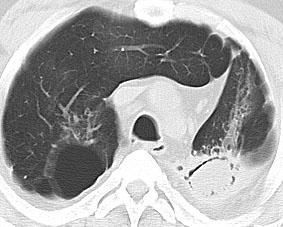 Aspergilloma (Mantar topu) Fungal Enfeksiyonlar Kavite içinde fungal hifa, sellüler debris ve mukus ve kals