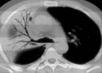 Lober Pnömoni Pnömoni Pulmoner ödem Alveolar hemoraji