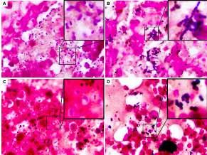 1918 pandemisinde postmortem inceleme bulguları % bacterial culture positive 100% 90% 80% 70% 60% 50% 40% 30% 20% 10% 0% Mikrobiyolojik verilerine ulaşılan influenza nedeniyle ölmüş 5266 olgu 24% 17%