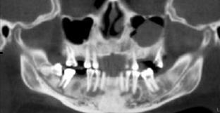 alınan panaromik radyografta mandibular sağ ikinci molar dişin apikalinde radyolusensinin yanı sıra, mandibulada kanin, premolar ve molar diş kökleri ile ilişkili radyolusent alanlar görüldü.