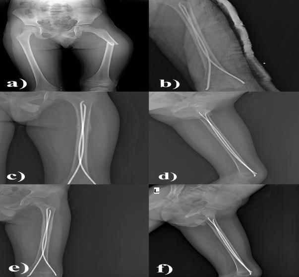 Demir ve ark. gibi birçok tedavi yöntemi tarif edilmiştir. Ancak, 5-11 yaş grubu çocuk femur kırıklarının tedavisinde elastik intramedüller nail sıklıkla kullanılmaktadır (1-6).