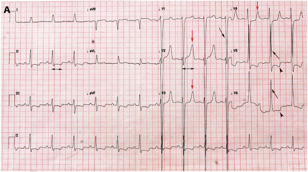 Figure 1. (A) ECG showing classical triad of CKD i.e. narrow-based tall T waves (red arrows) suggesting hyperkalemia,.