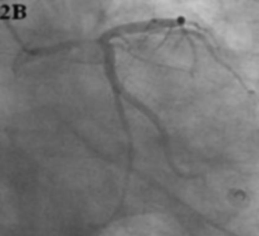 Balon anjiyoplastiden hemen sonra LMCA distal lezyonunun kaybolup akımın normale döndüğü anjiyografi görüntüsü Resim 2A ve 2B.