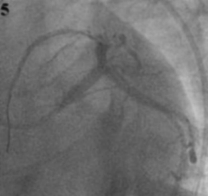 H. U. Yazıcı ve ark. Spontan koroner arter diseksiyonu tedavisi 301 ra LMCA daki stent stratları arasından geçilerek Cx arterdeki diseke segmente 3.5/20 mm stent 10 atmosferde implante edildi.