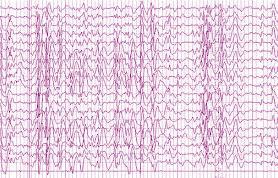 Epilepside yaşam boyu psikoz beklentisi %10 civarındadır. Genel popülasyonda yaşam boyu şizofreni beklentisi ise % 0.8 dur.