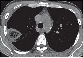 Pulmoner mukormikoz Geniş spektrumlu antibiyotiklere cevap vermeyen uzamış ateş Plöritik göğüs ağrısı ve ilerleyici dispne İnvaziv