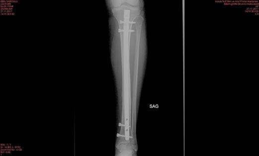 cerrahi yöntemler daha sık kullanılır olmuştur. Resim 1: Hastaya ait preop AP X ray görüntüsü. Resim 2: Hastaya ait preop lateral X ray görüntüsü. Resim 3: Hastaya ait postop AP X ray görüntüsü.