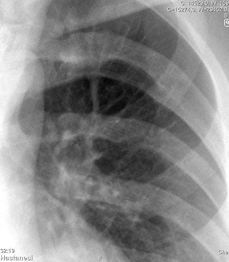 PAAC Subklavyen arterden çıkan ve skapulayı besleyen arterler, interkostal