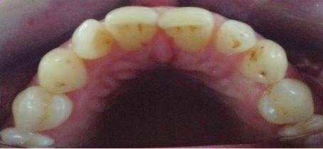 üst lateral dişinde rotasyon, alt anterior dişler hariç tüm dişlerinde abrazyon ve abfraksiyon lezyonlarının varlığı ve bu çürüksüz servikal lezyonlara bağlı hassasiyetinin olduğu tespit edildi