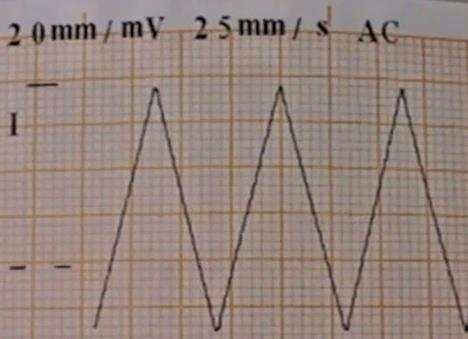 4. Sinyalin yeniden oluşturulmasına yönelik test için EKG cihazının duyarlılığı 10 mm/mv ve kağıt hızı 25 mm/sn olarak ayarlanır. Kalibratörden ayarlanan 2 Hz üçgen dalga 0.5, 1, 2.