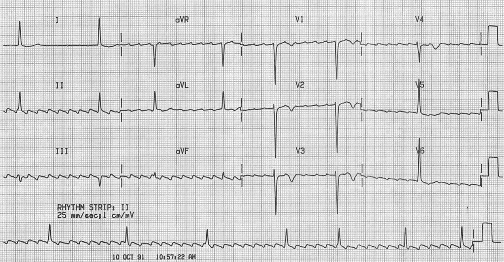 3 Atrial flutter +LVH Ritim düzensiz Kalp hızı: 40/dk Sol aks deviasyonu Flutter dalgaları: DII, DIII,