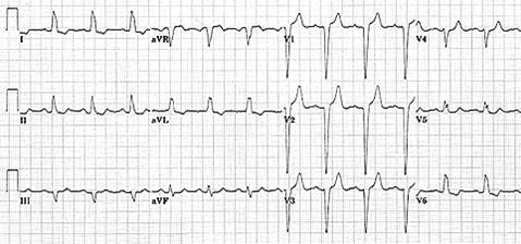 8 Sol dal bloğu Ritim düzenli Kalp hızı ~70/dk P dalgası var ve her P yi QRS takip ediyor Sol aks deviasyon DI, avl, V6