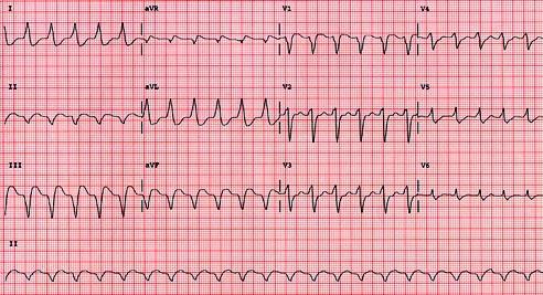 9 Ventriküler taşikardi Ritim düzenli Kalp hızı: 150/dk QRS genişlemiş (>0.