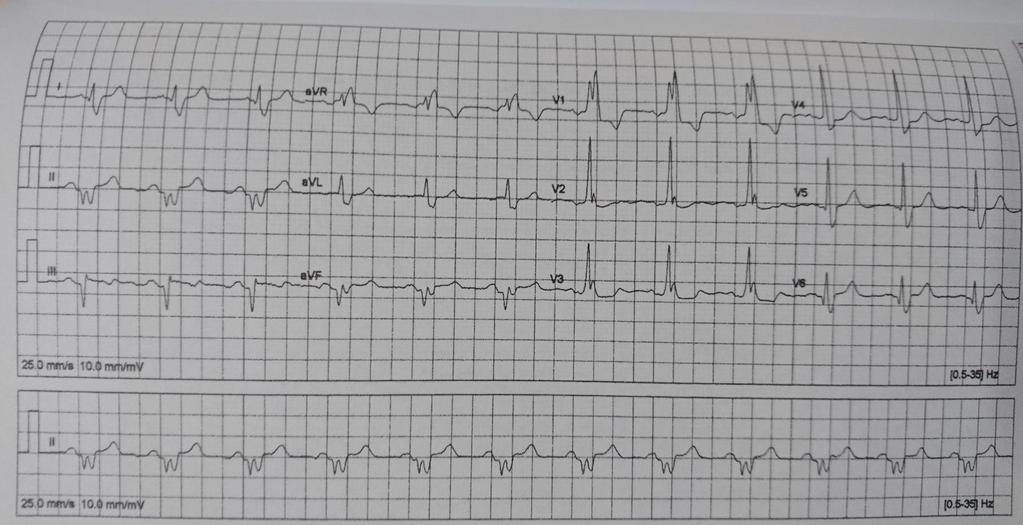 14 Sağ dal bloğu Ritim düzenli Kalp hızı: 75/dk Sol aks deviasyonu QRS genişlemiş(>0.