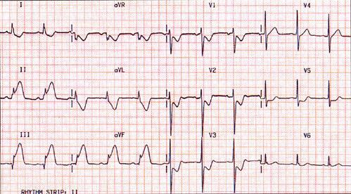 17 Hiperakut inferior MI Ritim düzenli Kalp hızı: 75/dk Normal aks DII, DIII, avf de ST