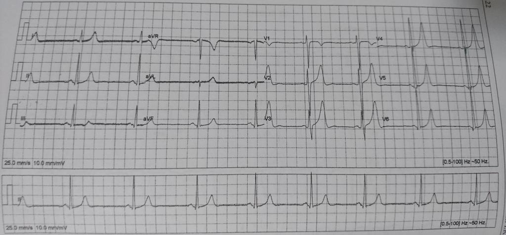25 Ritim düzenli LVH Kalp hızı:50/dk Normal aks (V2 S) + (V5 R) =