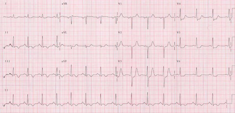 27 İnferolateral iskemi Ritim düzenli Kalp hızı:83/dk