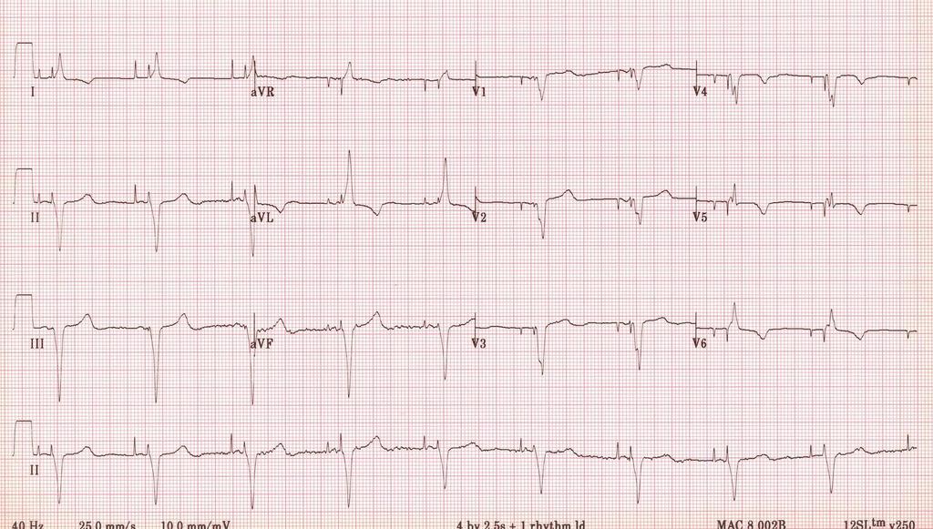 29 A-V sıralı pacemaker Ritim düzenli Kalp hızı:56/dk Sol aks