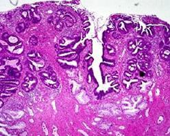 Adenokarsinoma insitu (AIS) Histopatolojik Tanım Stromal invazyon olmaksızın Mitotik figürler Genişlemiş hiperkromatik