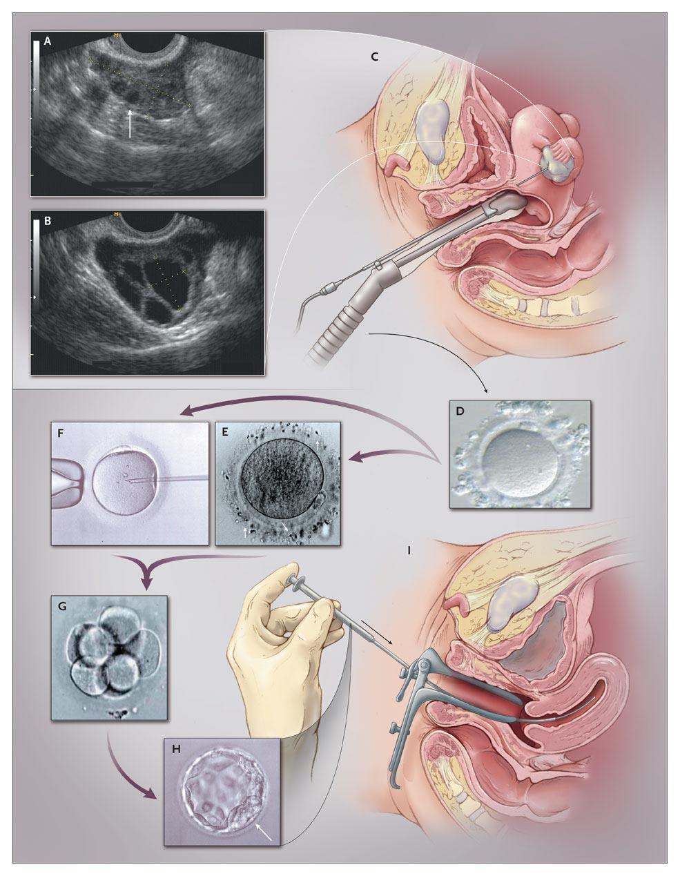 The Process of IVF Van Voorhis