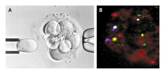 Biopsy and Preimplantation Genetic Diagnosis of a 3-Day-Old