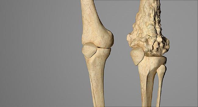 Malign hücreler tarafından osteoid veya olgunlaşmamış