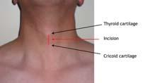 Boyna penetran travma (%10) Major damar yaralanması (karotid, vertebral, tiroid) Ciddi kan aspirasyonu Künt boyun travmasında
