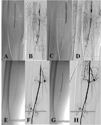 YFA daki multipl seviyelerdeki darlık segmentlerine PTA uygulanması sonrası (B-C) orta kesimde diseksiyon geliştiği (D) ve bu nedenle 6x80 mm boyutlarında stent ile tam patensi sağlandığı izlenmekte