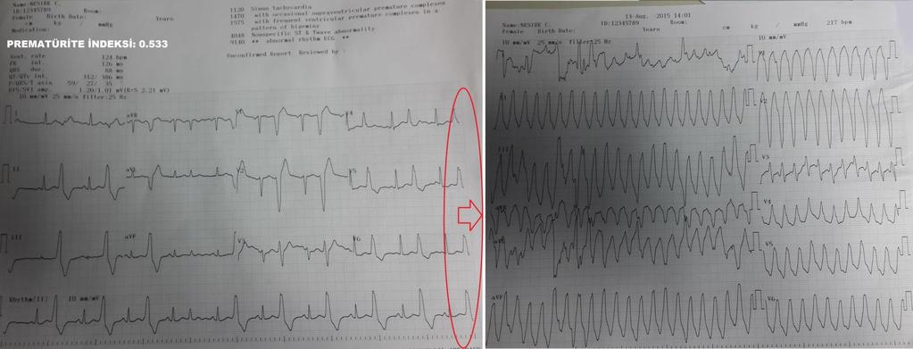 KYBÜ de Çekilen EKG 220 atım/dk hızında VT gelişen hastanın hemodinamisi