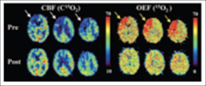 Hastalığı Ogasawara et al Stroke