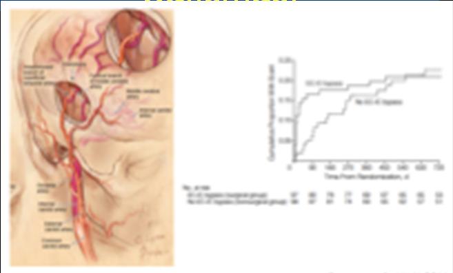 Stroke 2005 Karotis Oklüzyon