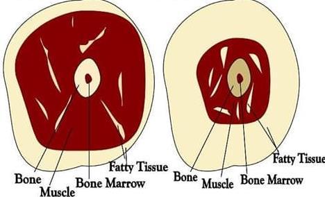 Obezitenin patogenezi Yaşlılarda fiziksel aktivitenin azalması, besin alımının değişmesi, hormonal değişiklikler ve düzenleyici mekanizmaların