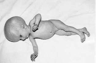 Fetustaki Patolojiler Abortus Ölü doğum
