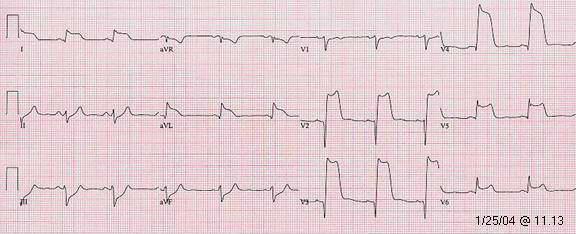 Anterolateral: V4-V6