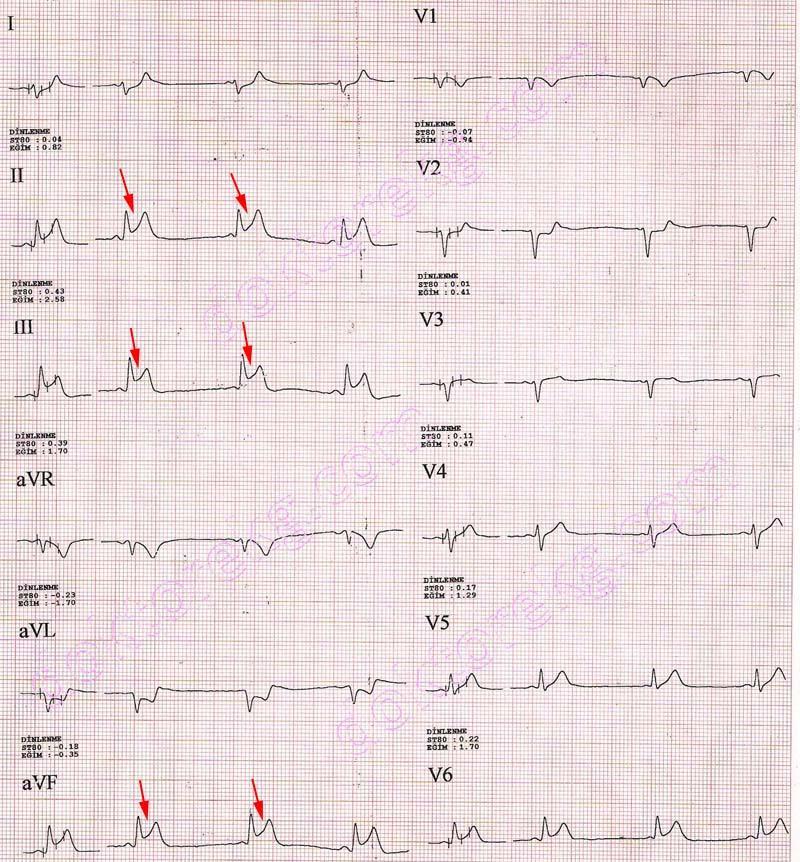 DI-aVL İnferior: