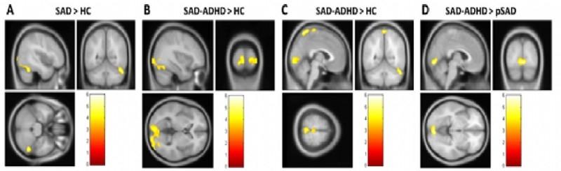 1) Etkin, A. and T. D. Wager (2007). "Functional neuroimaging of anxiety: a meta-analysis of emotional processing in PTSD, social anxiety disorder, and specific phobia.