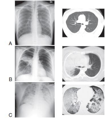 NORMAL/KISMEN NORMAL Astım, KOAH atak, NM Hast, SSS Hast, PTE LOKALİZE ALVEOLER DOLUM PATERNİ