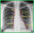 Kollajen Doku Hastalıklarında Diffüz Parankimal Akciğer Tutulumu