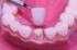 Restoratif Diş Hekimliğinde Zirkonyum Uygulamaları
