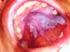 Kemoterapi Alan Hastalarda Görülen Oral Mukozitin Önlemesi ve Tedavisinde Güncel Yaklaşımlar: Kanıta Dayalı Uygulamalar